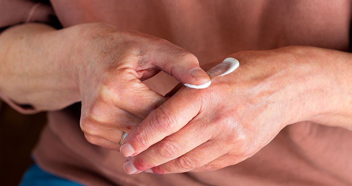 Senhora aplica creme para tratar a pele com dermatite atópica